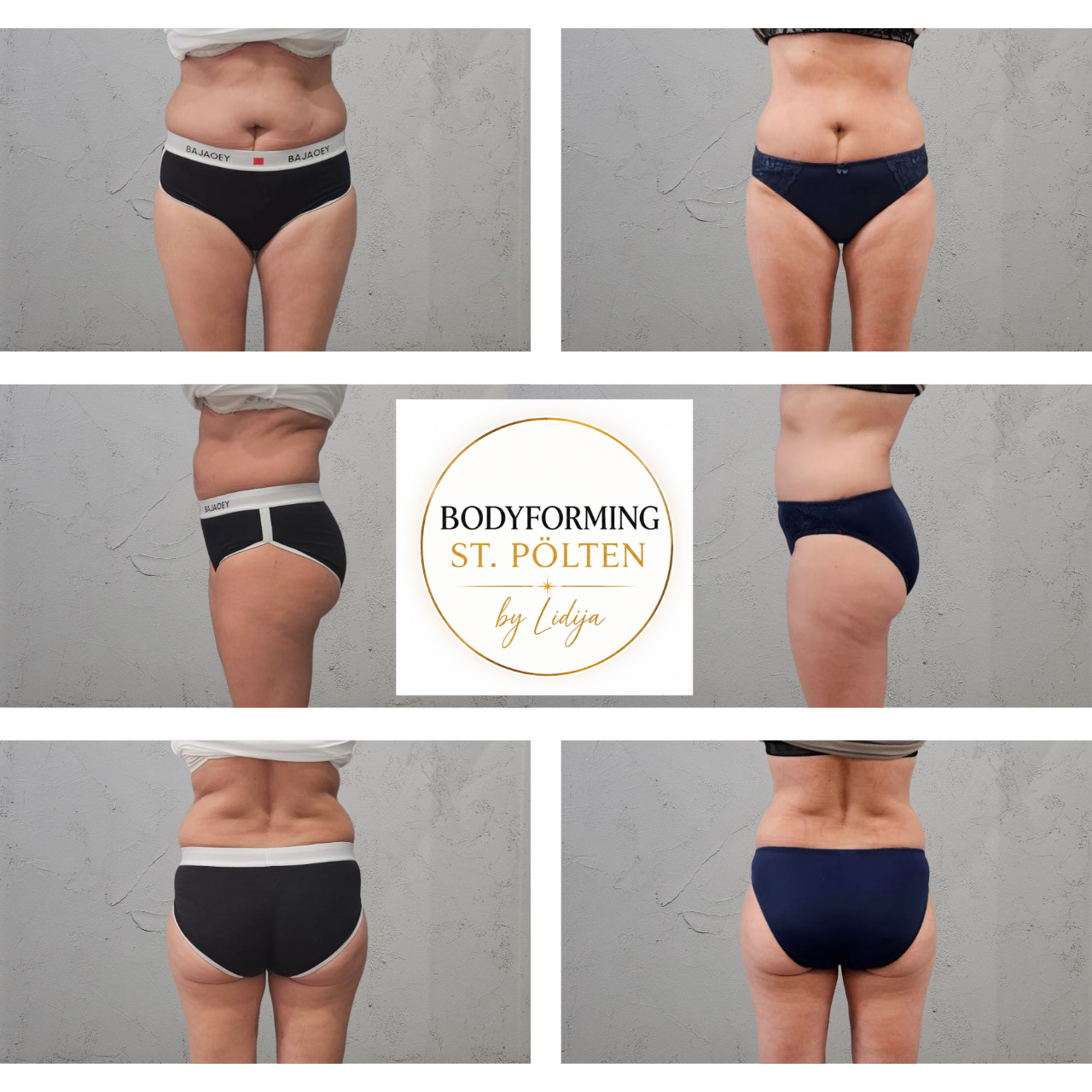 Vorher-Nachher Ergebnis – Bodyforming St. Pölten by Lidija